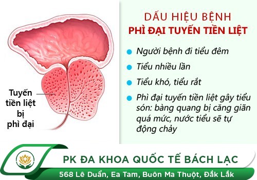 Phì đại tuyến tiền liệt