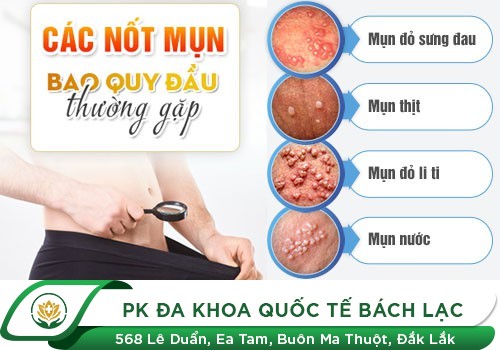 Vành bao quy đầu nổi mụn là biểu hiện của bệnh gì?