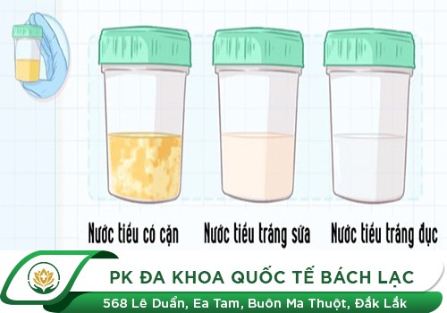Nước Tiểu Đục Có Cặn Là Triệu Chứng Của Bệnh Lý Gì