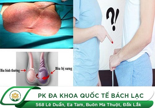 Nguyên Nhân Sưng Vùng Bìu Tinh Hoàn Ở Nam Giới