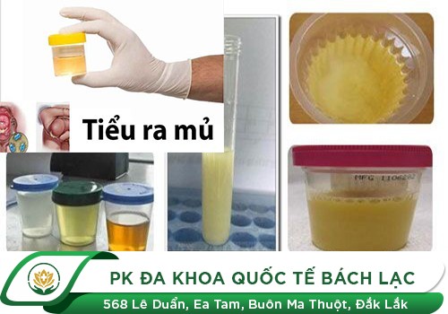 Tiểu Ra Mủ Là Bệnh Gì