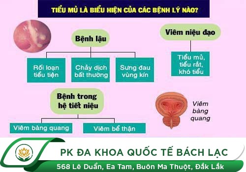 Tiểu ra mủ - dấu hiệu của các bệnh nam khoa khác ngoài bệnh lậu