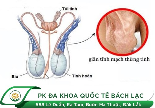Sưng vùng bìu nguyên nhân do đâu?