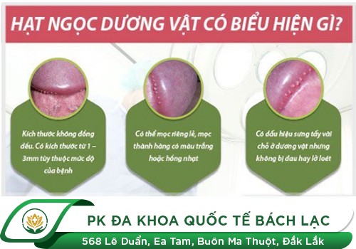 Hạt ngọc dương vật có nguy hiểm không?