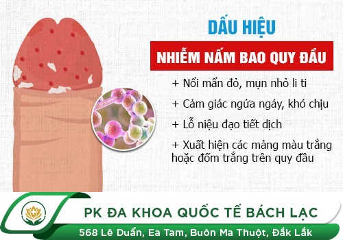 Nấm bao quy đầu