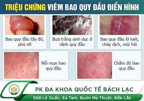 Hẹp bao quy đầu