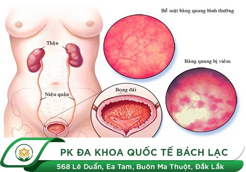 VIÊM BÀNG QUANG CẤP LÀ GÌ?