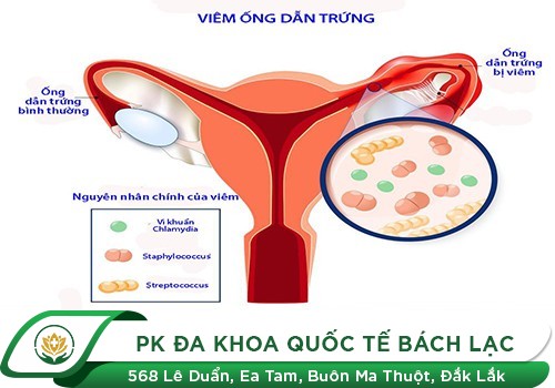 Đau bụng dưới ở nữ giới