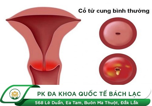 Bệnh Viêm Tử Cung Ở Nữ Giới Và Những Điều Cần Biết
