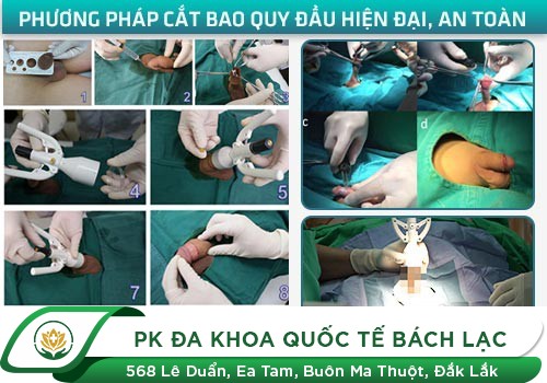 Địa Chỉ Cắt Da Quy Đầu Stapler Uy Tín Chất Lượng Ở Đắk Lắk