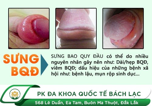 Vì Sao Nam Giới Bị Sưng Bao Quy Đầu Sau Khi Quan Hệ