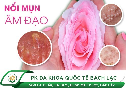 Cẩn Thận Với Hiện Tượng Nổi Mụn Ở Môi Lớn, Môi Bé Âm Đạo
