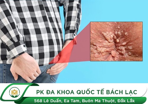 Hậu môn nổi mụn thịt là dấu hiệu của bệnh gì?