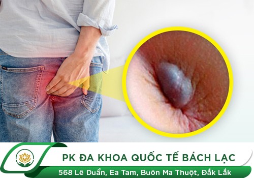 Hậu môn nổi cục thịt có phải bị trĩ không?
