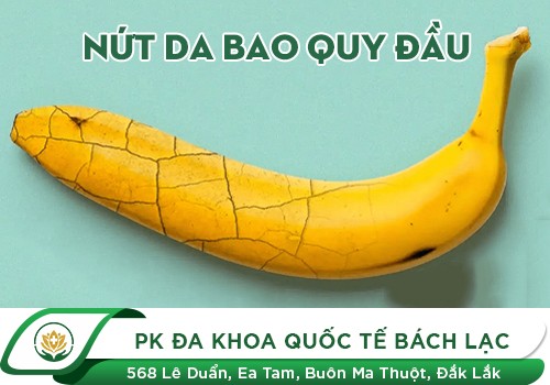Cách chữa nứt da bao quy đầu hiệu quả
