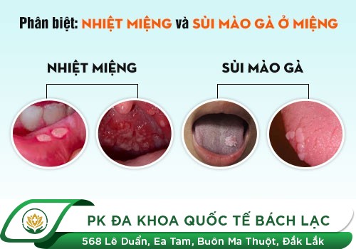 Triệu Chứng Sùi Mào Gà Ở Miệng Và Cách Điều Trị