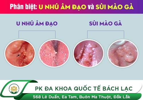 Hình Ảnh Sùi Mào Gà Ở Nữ