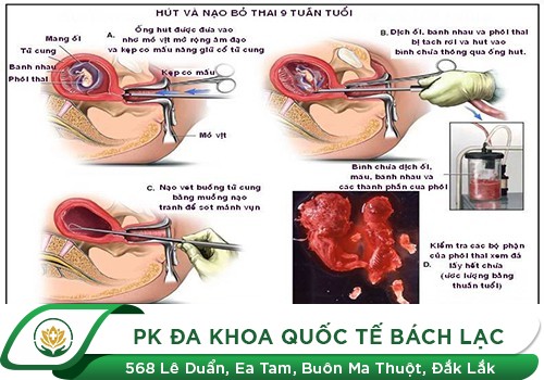 Nạo hút thai là gì?