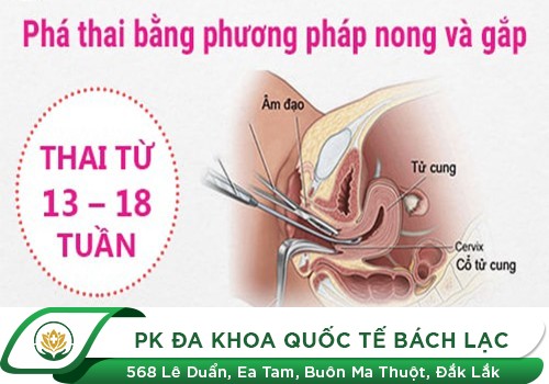 Thai 13 tuần phá được không? Những cách phá thai 13 tuần mới, hiện đại không đau hiện nay?
