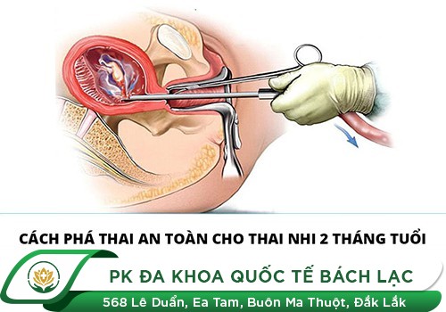 Phương Pháp Phá Thai 2 Tháng Tuổi Tại Chuyên Khoa