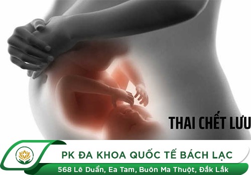 Cách xử lý thai chết lưu cho thai phụ