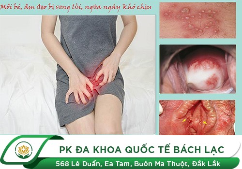 Vùng Kín Bị Sưng Dấu Hiệu Cảnh Báo Bệnh Lý Nguy Hiểm