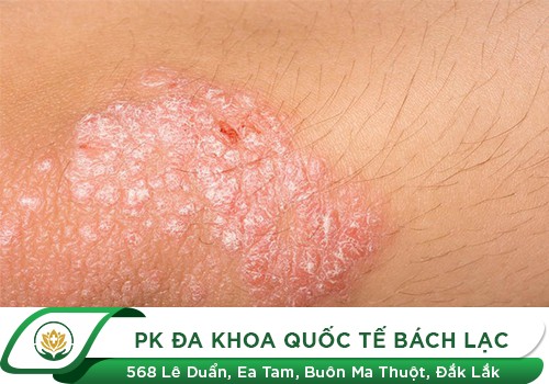 Bị Chàm Vùng Kín Nữ Giới Chữa Trị Như Thế Nào