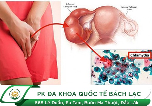  chlamydia