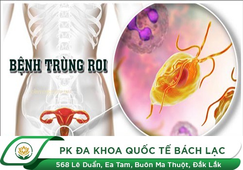 Viêm âm đạo do trùng roi trichomonas