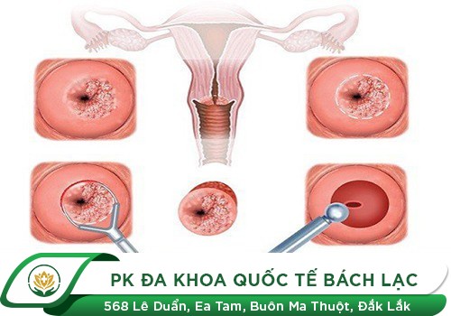 Dịch âm đạo có mùi hôi, dấu hiệu viêm nhiễm phụ khoa nguy hiểm
