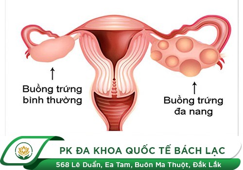 Hội chứng buồng trứng đa nang 