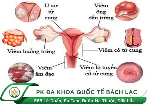 Phương Pháp Dao LEEP - Giải Pháp Tối Ưu Cho Chị Em Bị Bệnh Tử Cung