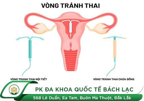 Bạn Đã Hiểu Rõ Việc Đặt Vòng - Tháo Vòng Tránh Thai Chưa