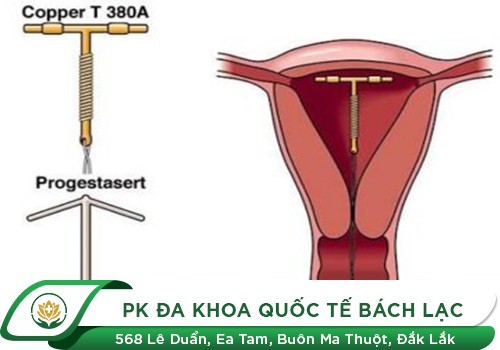 Địa Chỉ Đặt Vòng Tránh Thai An Toàn Ở Đắk Lắk