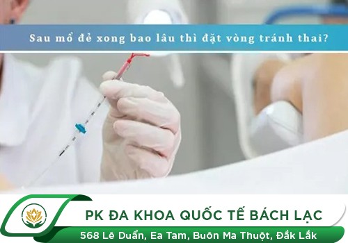 Sinh Xong Bao Lâu Có Thể Đặt Vòng Tránh Thai