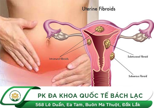 Vì Sao Chị Em Bị Đau Tử Cung