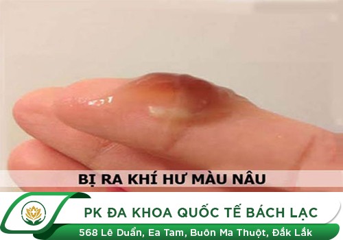 Khí hư có màu đen là biểu hiện của bệnh gì