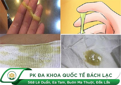 Huyết trắng có màu xanh là dấu hiệu của bệnh gì