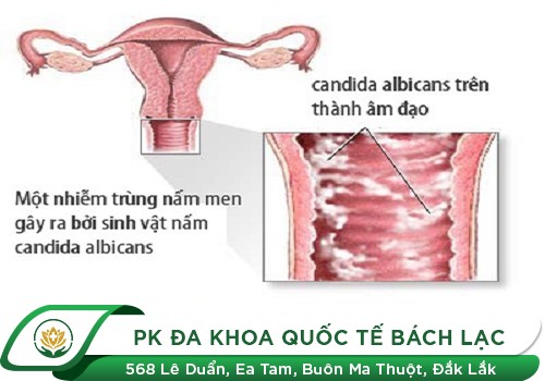 Làm Sao Để Hết Nấm Ngứa Vùng Kín Mà Không Bị Tái Đi Tái Lại?
