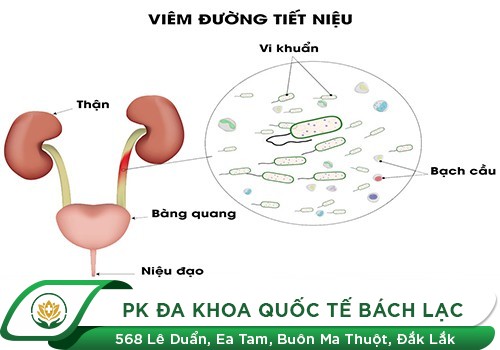 Nhiễm Trùng Đường Tiểu, Những Điều Chị Em Cần Biết