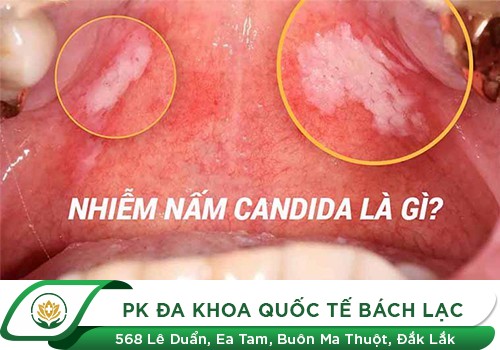 Nấm Candida, dấu hiệu nhận biết và cách trị hiệu quả