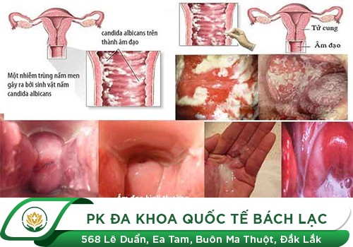 Triệu chứng nhận biết bệnh viêm nấm âm đạo