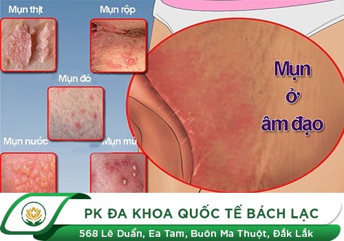 Vì Sao Cô Bé Bị Nổi Mụn