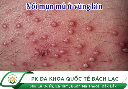 Nổi Mụn Thịt Ở Vùng Kín Nữ Là Bệnh Gì