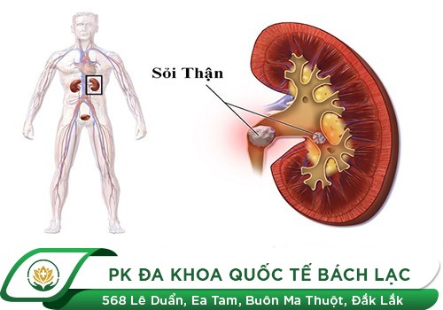  Sỏi thận