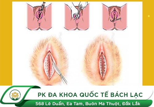 Báo Giá Dịch Vụ Vá Màng Trinh Bao Nhiêu Tiền Hiện Nay