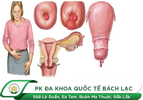 Thịt Thừa Cổ Tử Cung Là Gì, Có Nguy Hiểm Không