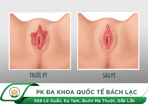 Phương Pháp Thu Hẹp Vùng Kín Hiệu Quả Dành Cho Nữ Giới