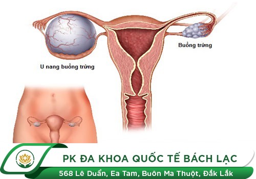  U nang buồng trứng
