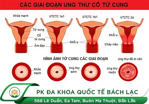 Ung thư cổ tử cung
